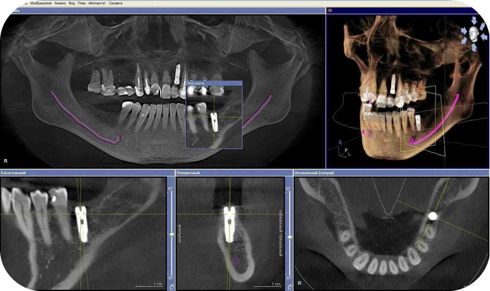 КТ зубов , панорамный снимок , рентген зуба , компьютерная томография