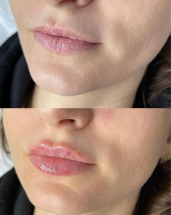 Косметолог. Увеличения Губ. Углы Джоли , скулы , Подбородок. Ботокс .