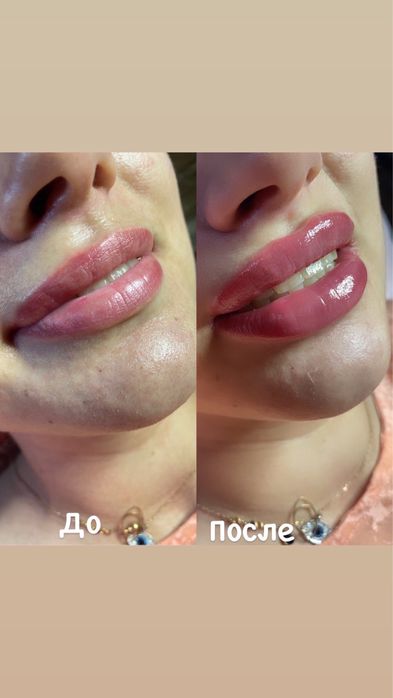 Увеличение Губ, Ботокс, контурная пластика, Обучение