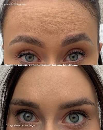 Botox 3 strefy- Modelki Żyrardów i okolice