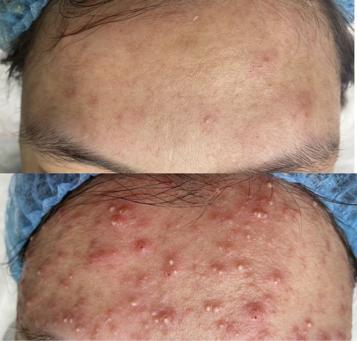 Лечение акне, врач дерматолог , врач косметолог.