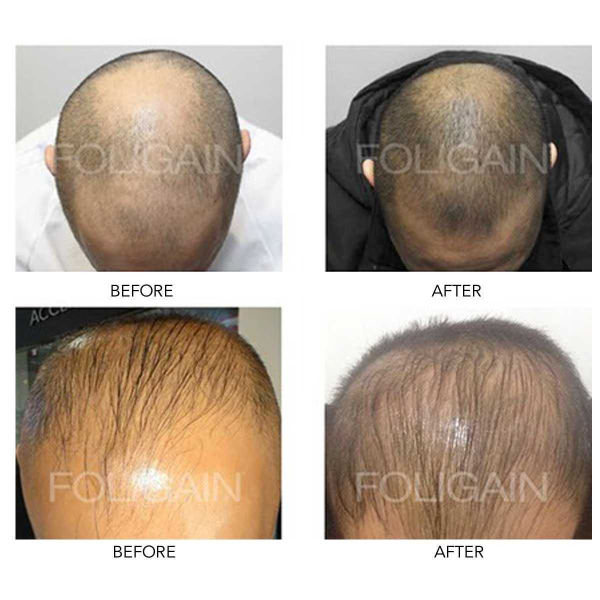 kit 3 Minoxidil tb versão baixo Álcool Entrega Grátis em Cascais