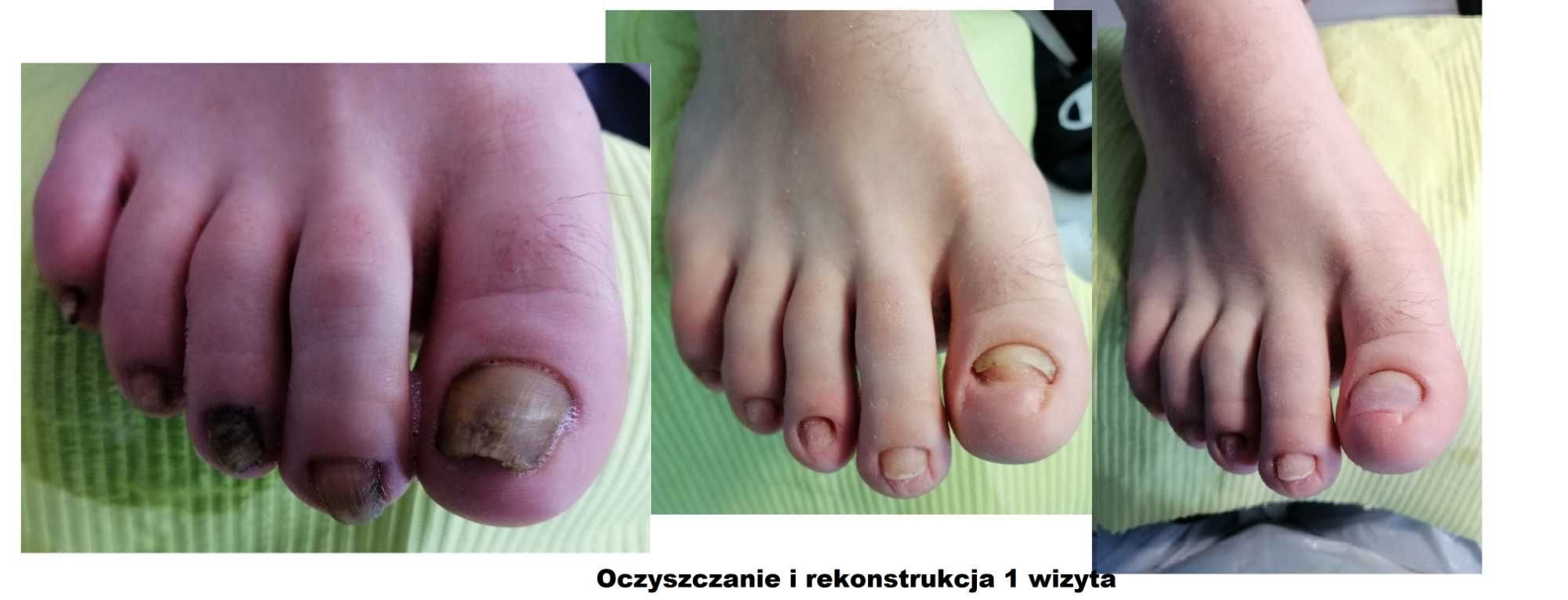 Podolog z dojazdem do domu, pedicure