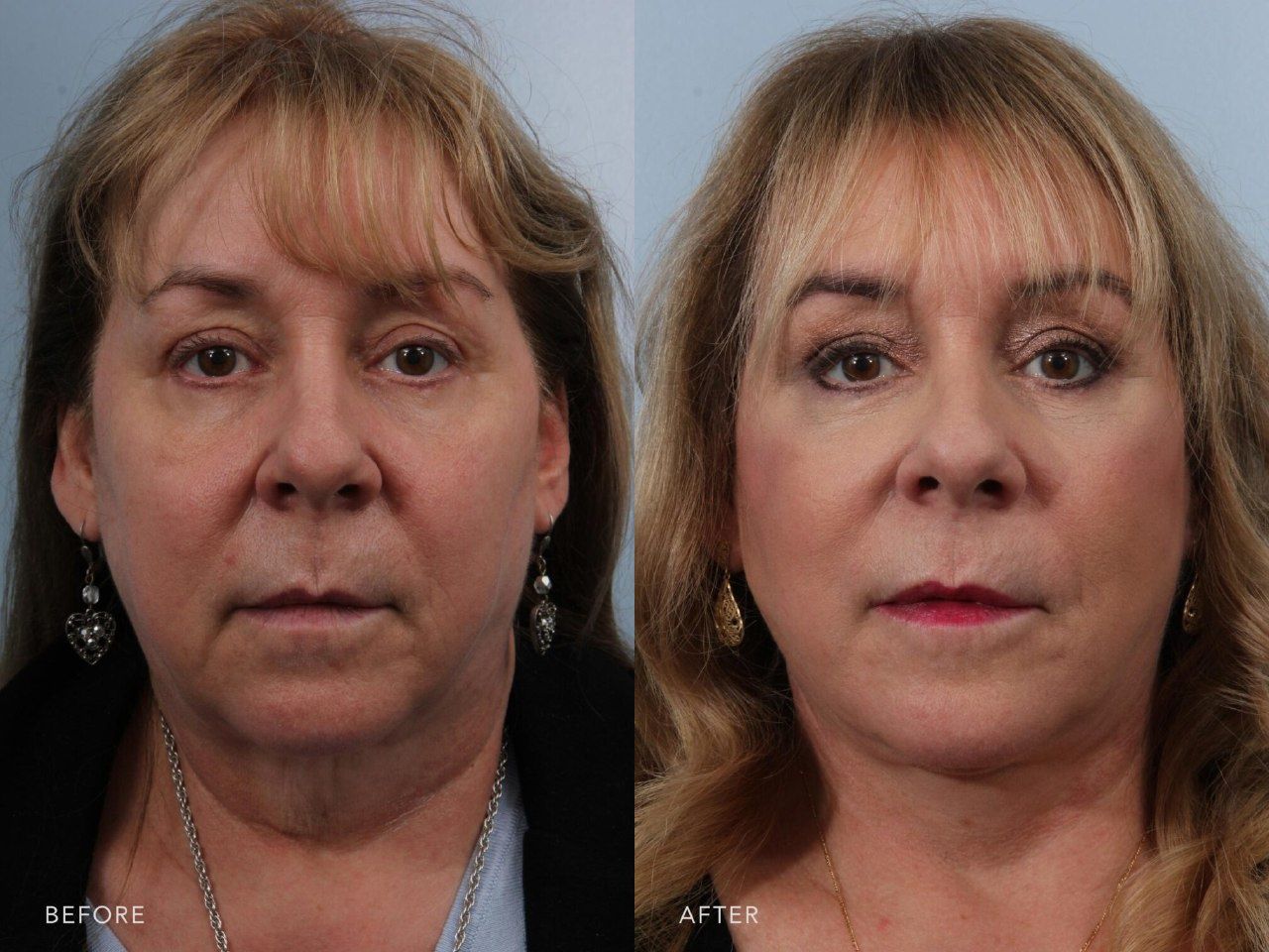 Массаж Access Bars и Facelift-32 точки.Омоложение лица и тела   .