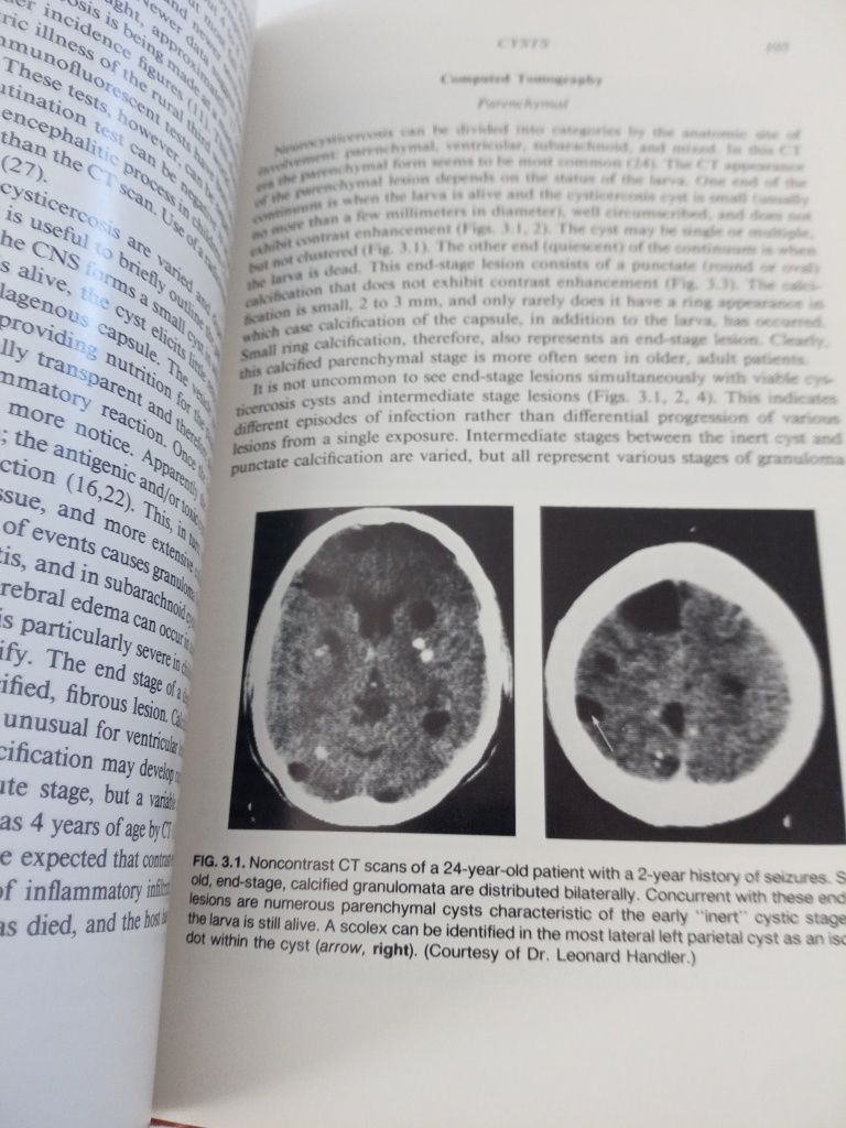 Imaging of Infections and inflammtions of the central nervous system