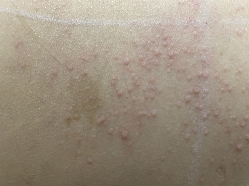 Serviço de depilação a laser