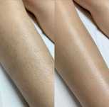 Depilação laser tripla onda