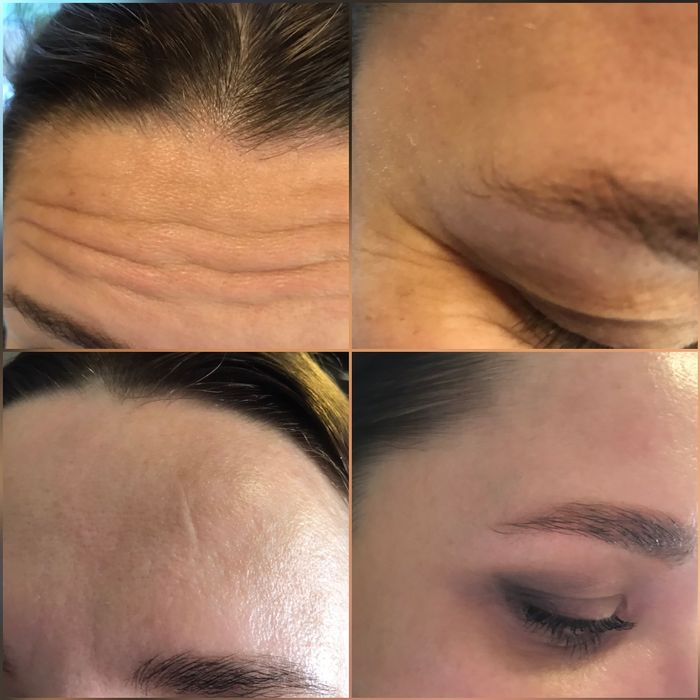 Косметолог Київ, Працюю!!  Акція Ботокс 2500 3 зони.