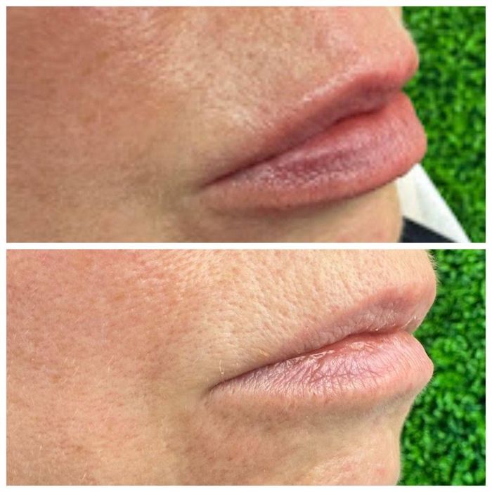 Ботокс| Збільшення губ