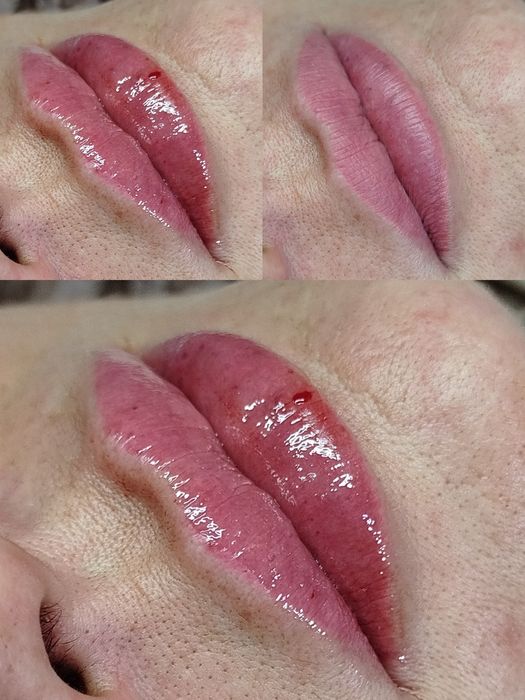 Modelowanie i powiększanie UST - 450 zł. 1 ml.