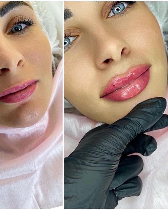 Увеличение губ, ботокс