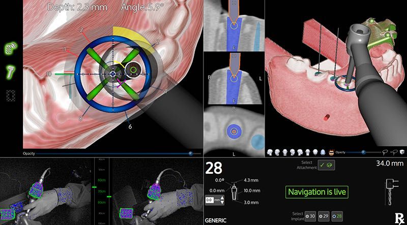 Aparelho de cirurgia Navegada X-Guide