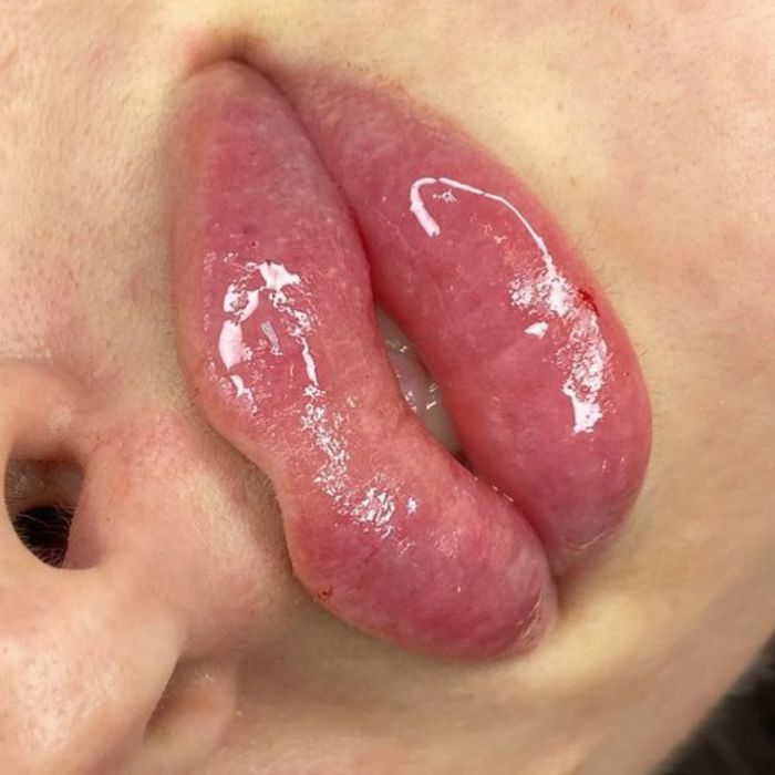 Контурная пластика губ. Ботокс