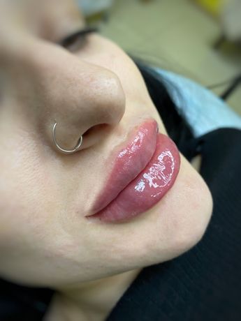 Ін‘єкційні процедури,збільшення губ