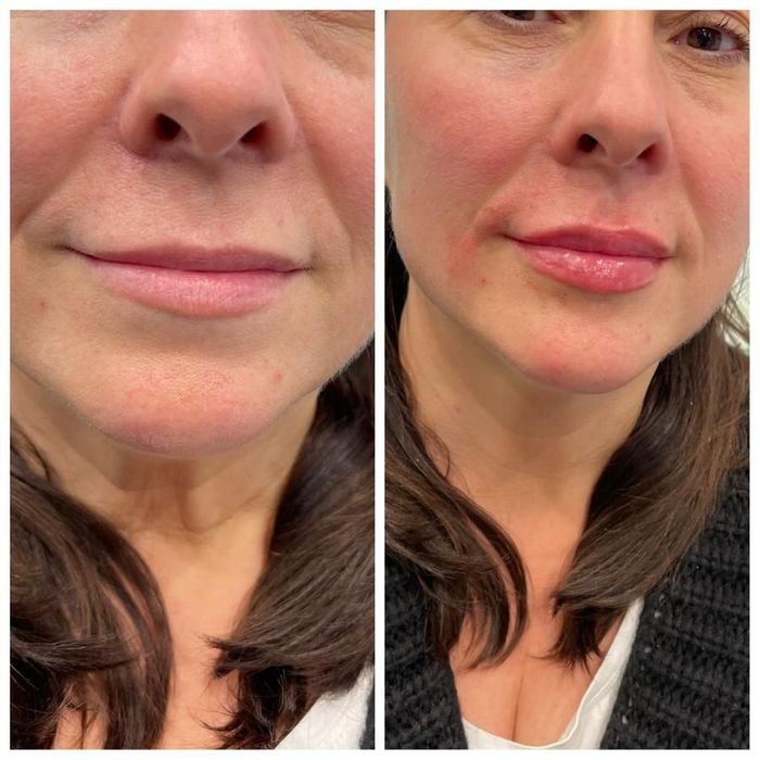 -10/procent na wszystkie zabiegi. Botox ,powiększanie ust .