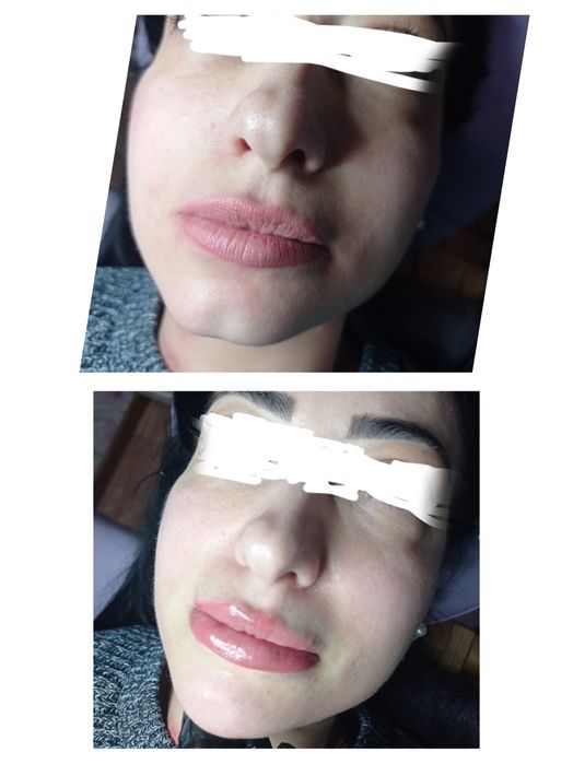 Косметолог Кривой Рог(губы, ботокс,чистка лица)