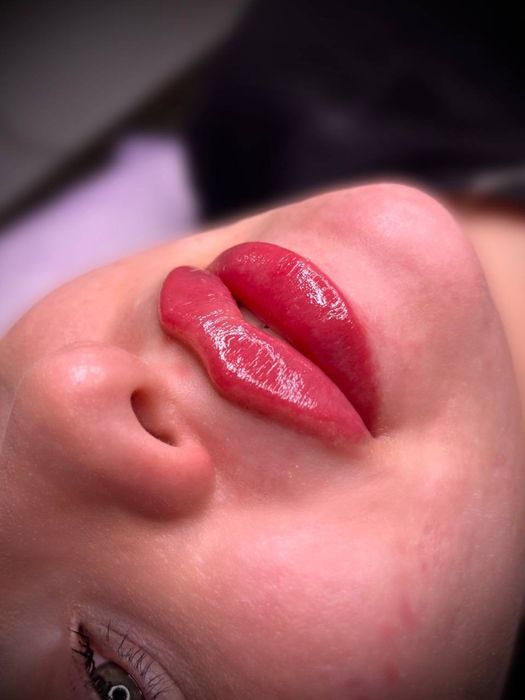 Косметолог Николаев ,губы 3500,ботокс биоревитализация