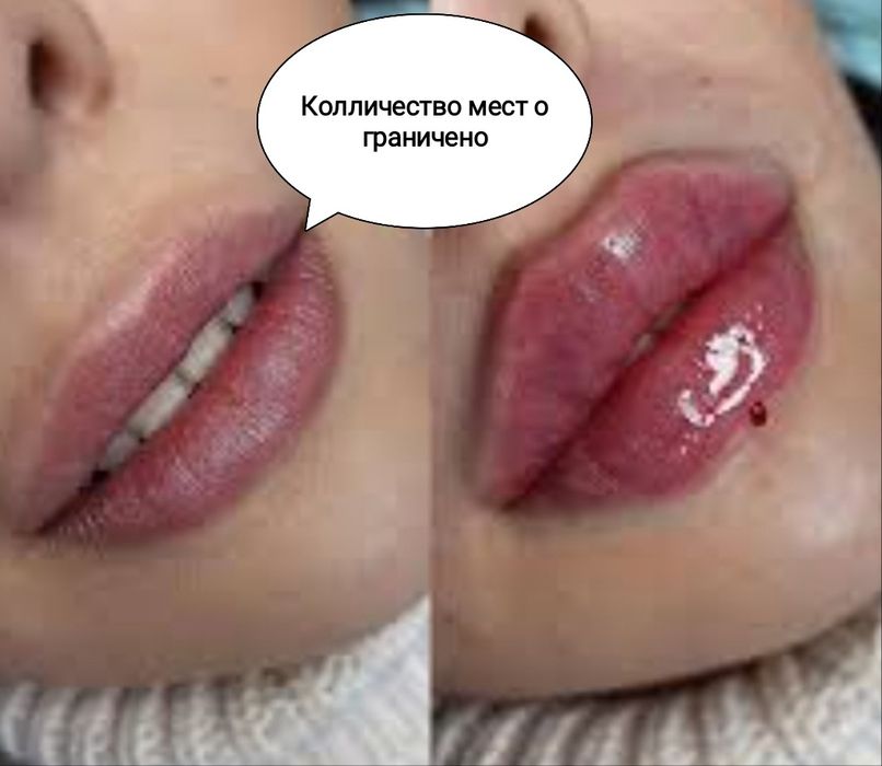 Увеличение губ - 1600. Колличество мест ограничено!