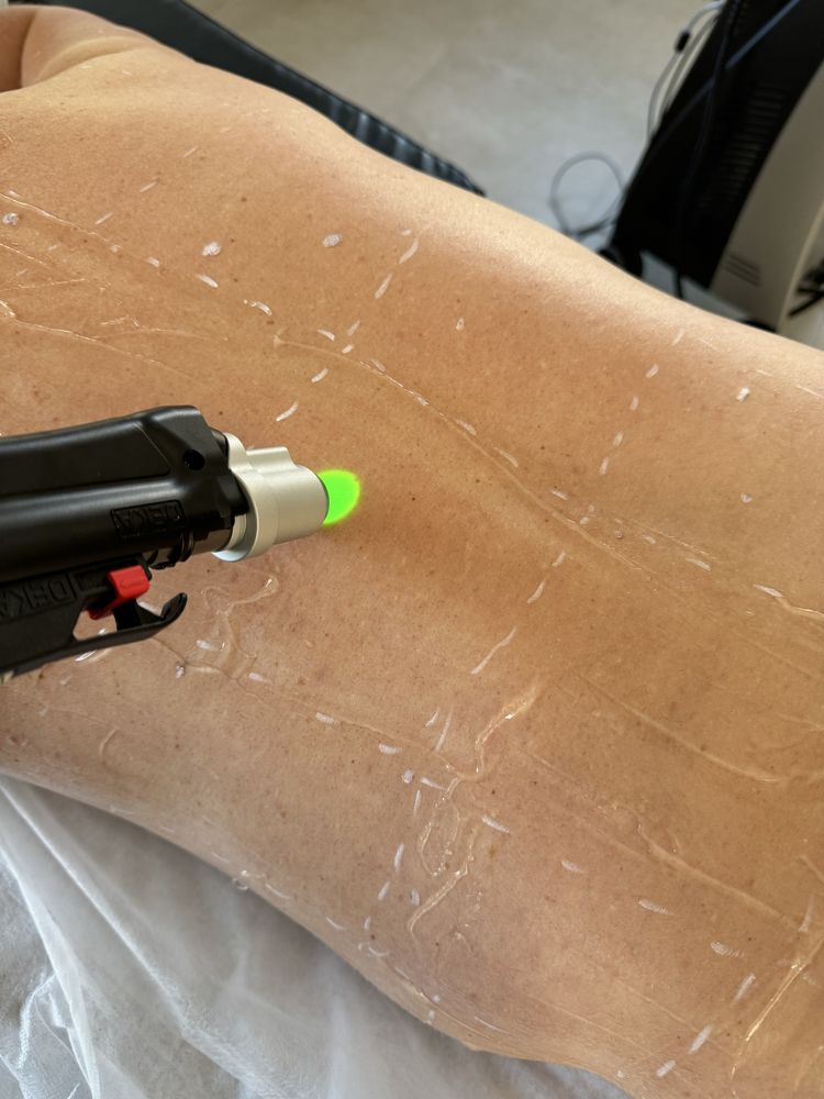 Depilacja laserowa modelowanie ciała i sylwetki Gorzów Wlkp.