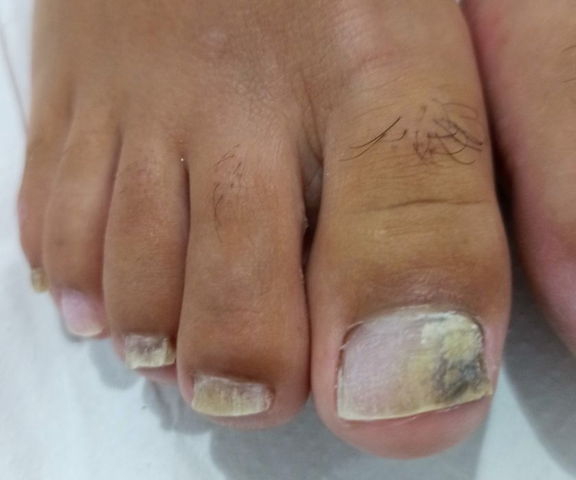 Tratamento para Micose nas Unhas – Resultados Garantidos!