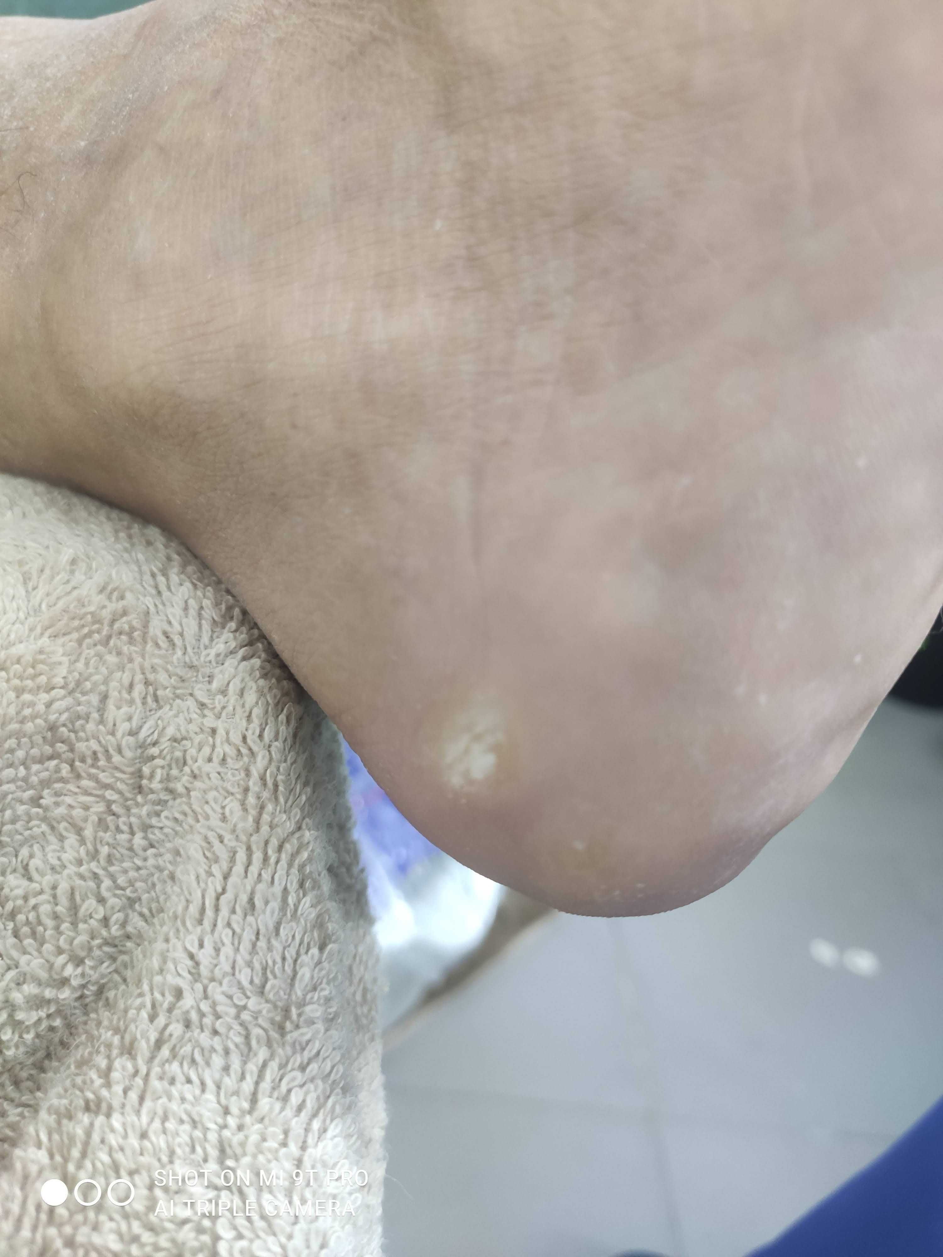 TRATAMENTO DE CALOS/UNHAS ENCRAVADAS (masculino/feminico)