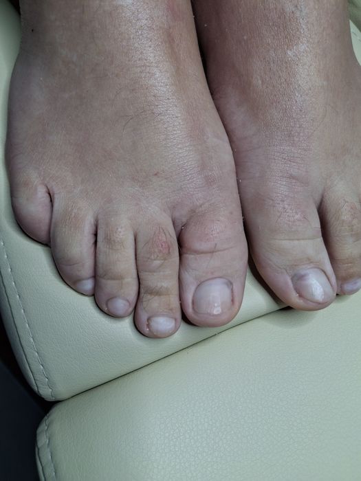 Медичний педикюр