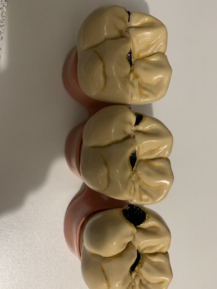 Modelo didático evolucão caries