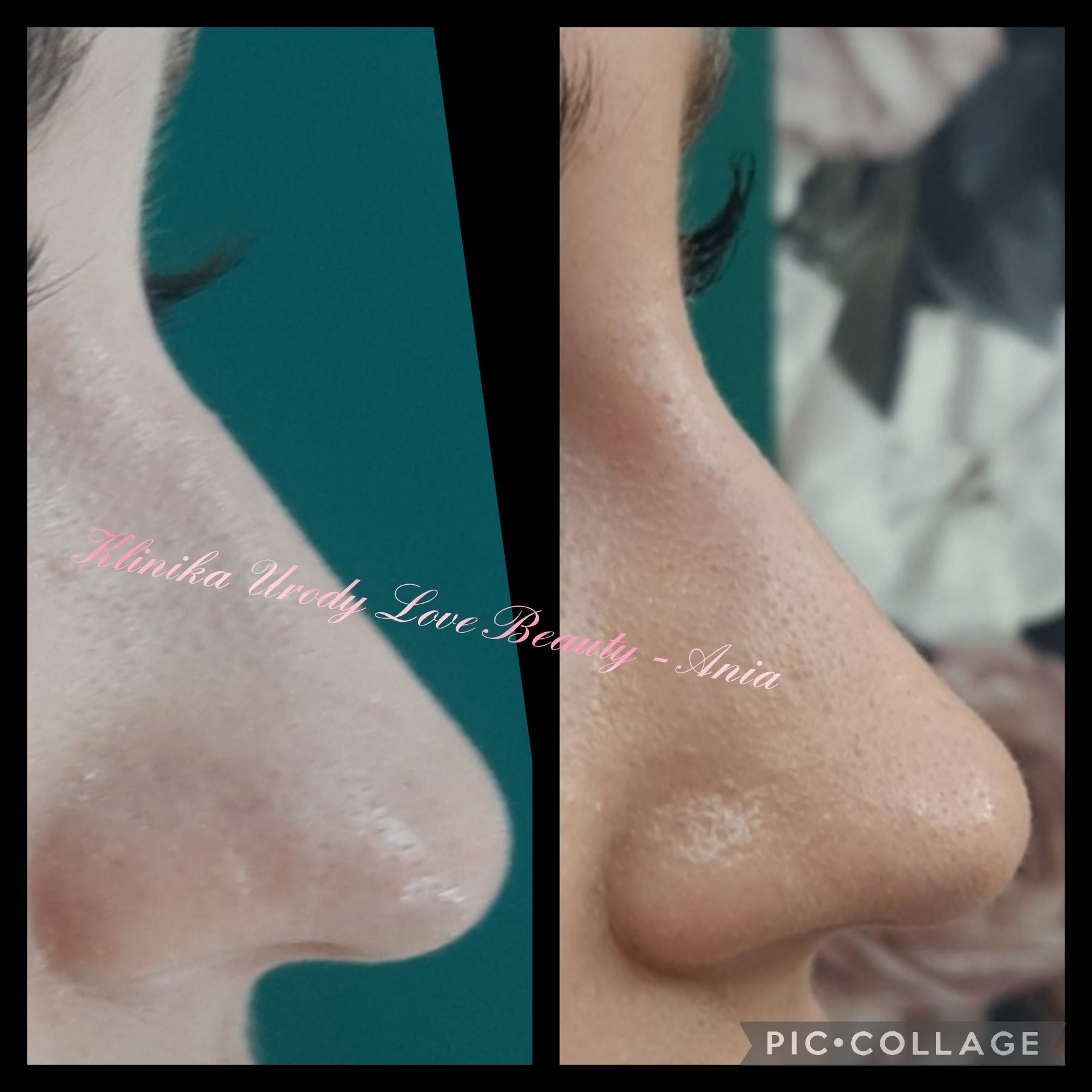 PROMOCJA botox powiększanie ust hialuronowy laser HIFU