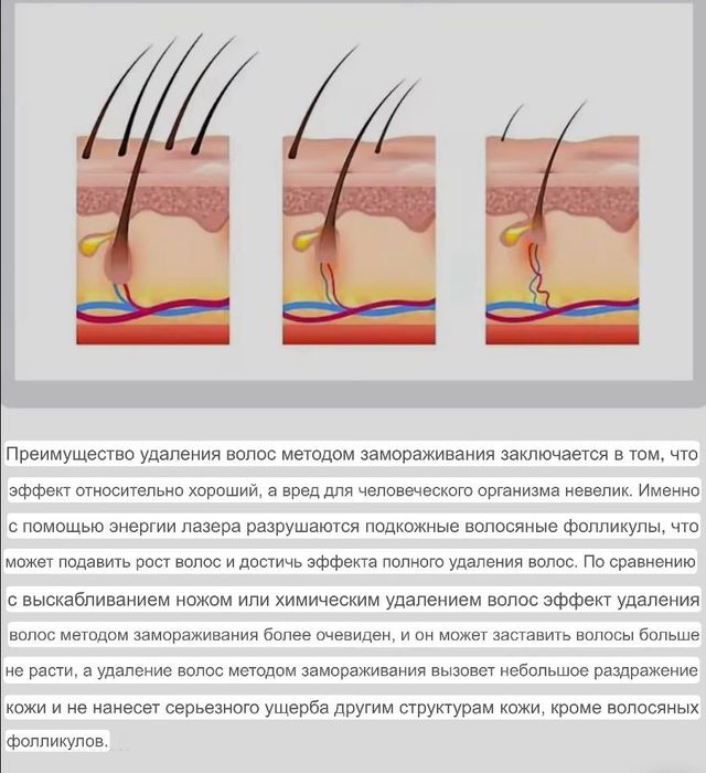 Професійний апарат IPL+OPT: епіляція та омолодження шкіри.