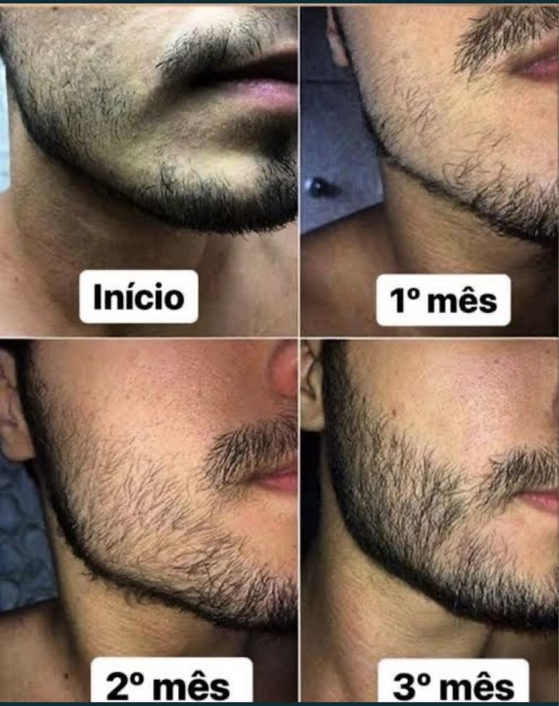 Minoxidil.Acabe com a calvície ! Crescimento de barba