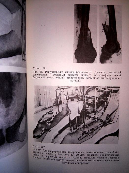 Ключевский Скелетное вытяжение 1991