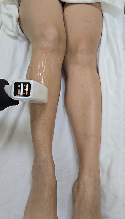 Продам лазерний апарат