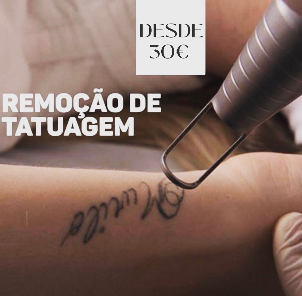 Remoção de tattoo