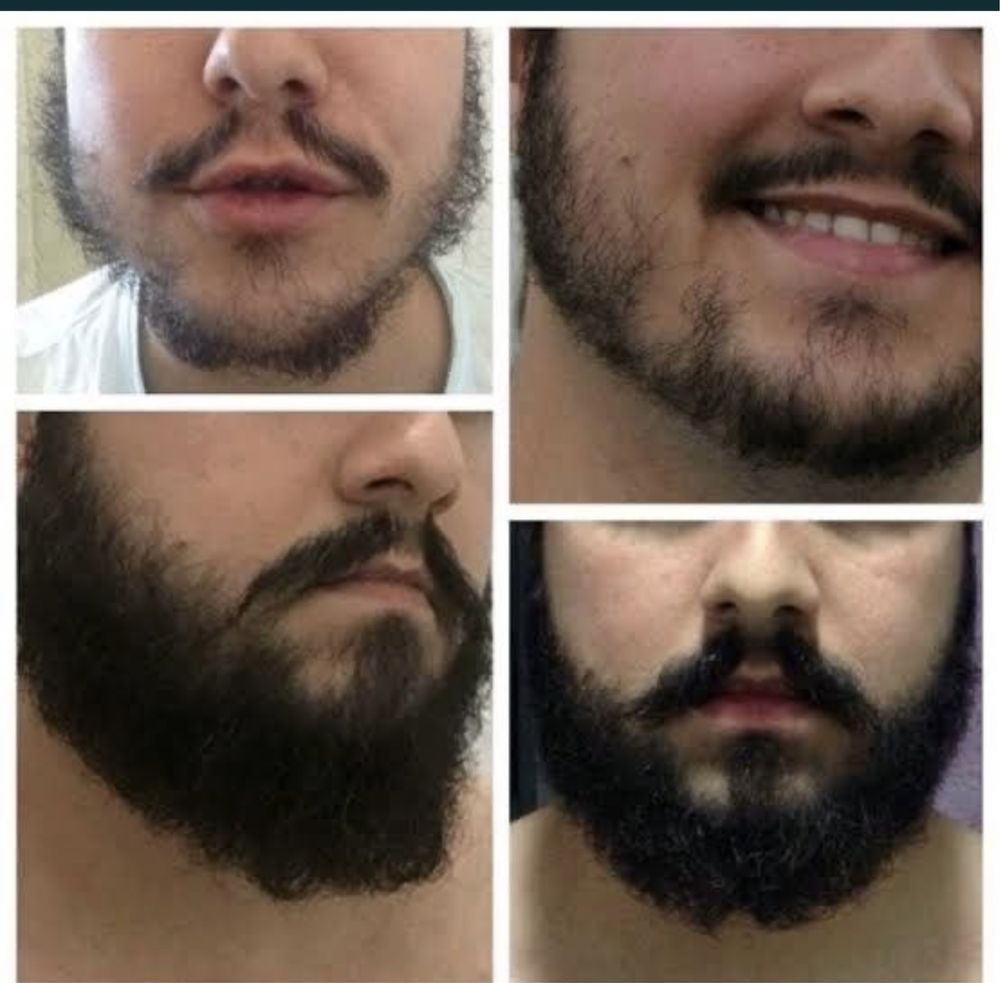 Minoxidil.Acabe com a calvície ! Crescimento de barba