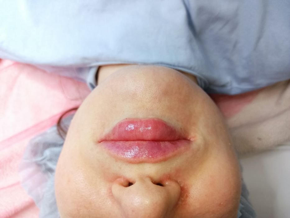 Косметолог, Біоревіталізація, Ботокс, Контурна пластика , мезотерапія.