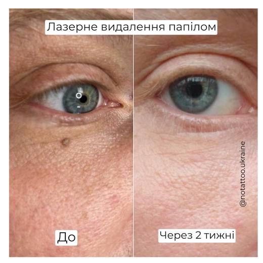 Лазерне видалення папілом