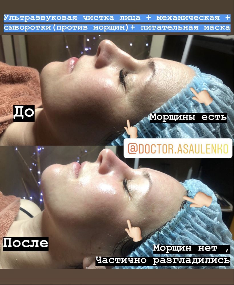 Косметолог/Голівудська чистка/Ультра звукова/Пілінги/Ручна