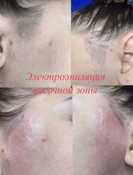 Электроэпиляция на Салтовке!