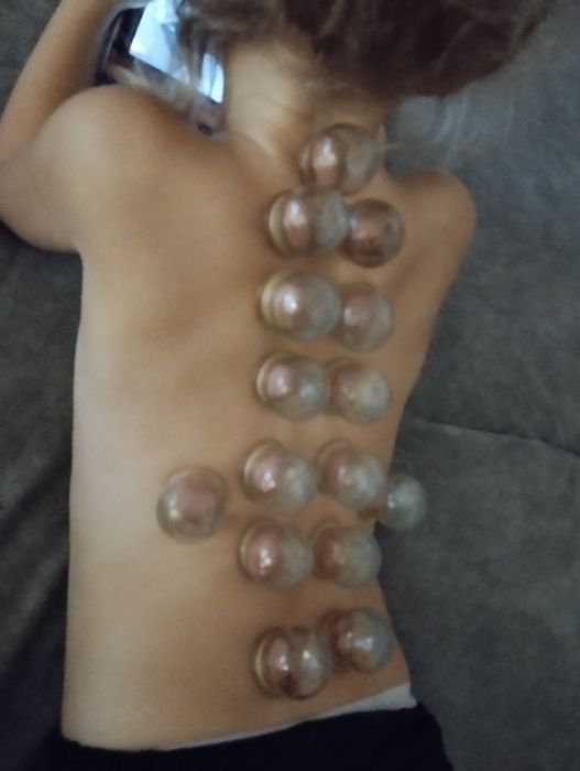 Stawianie baniek ogniowych, bańki lekarskie, bańki ogniowe