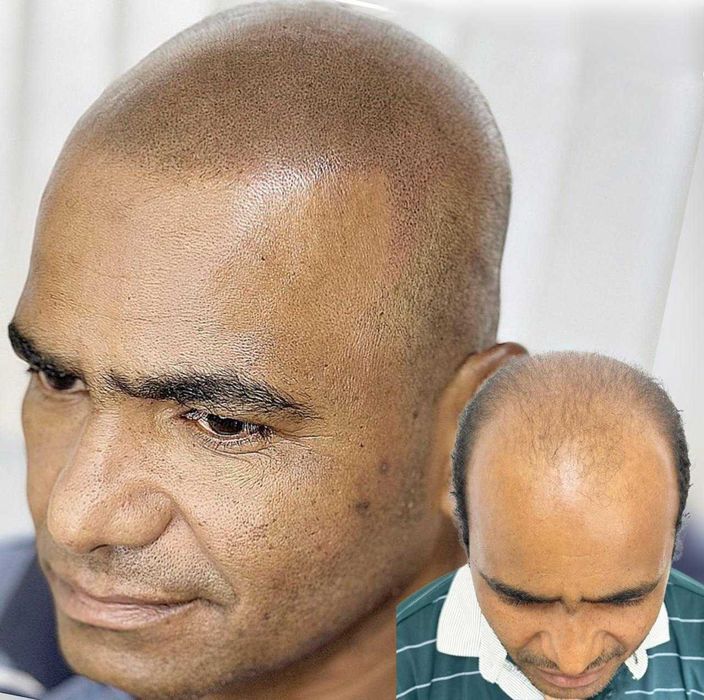 Micropigmentação capilar.