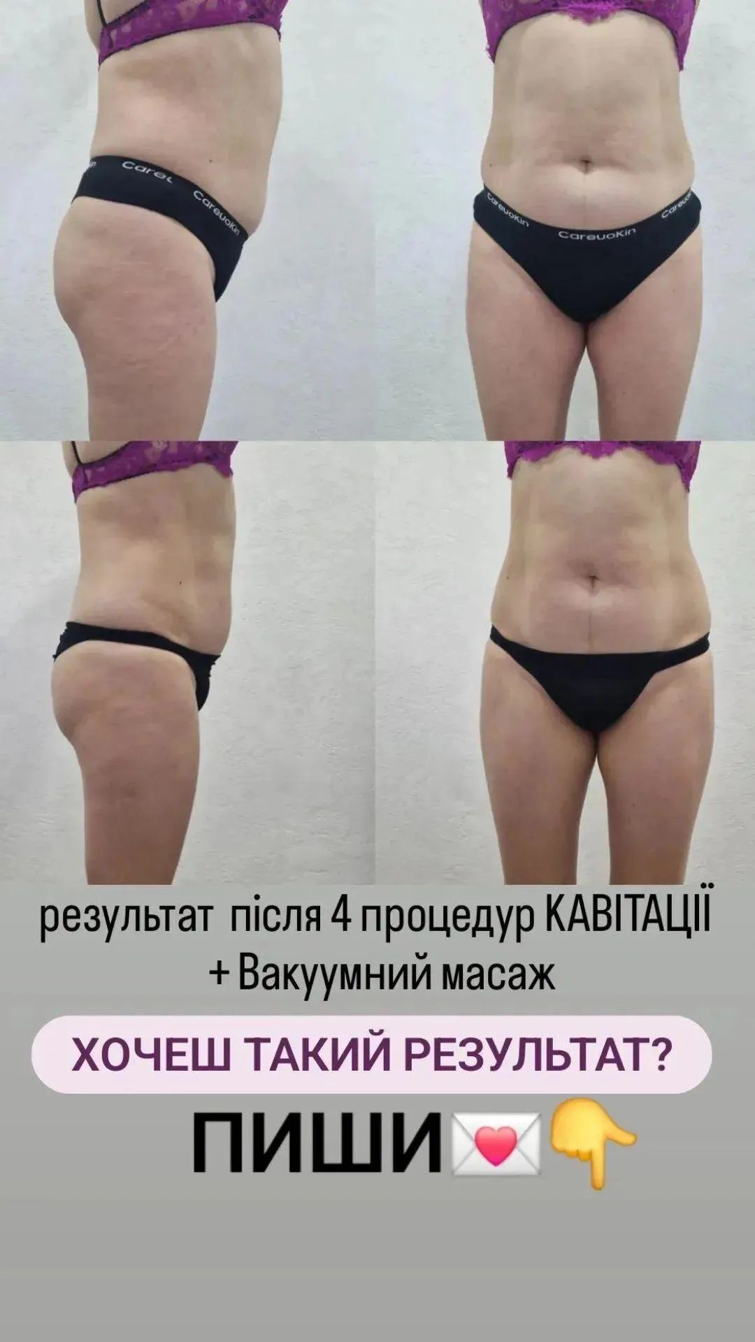Апаратні процедури / масаж / Вакуумний масаж
