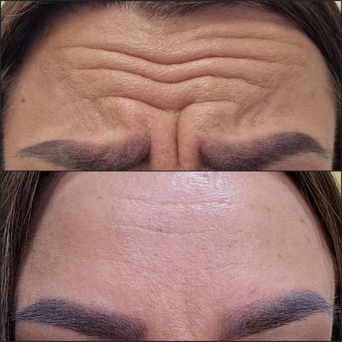 BTX , wygładzenie zmarszczek