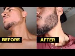 Crescimento Barba/Cabelo Minoxidil 5% Original Kirkland promoção