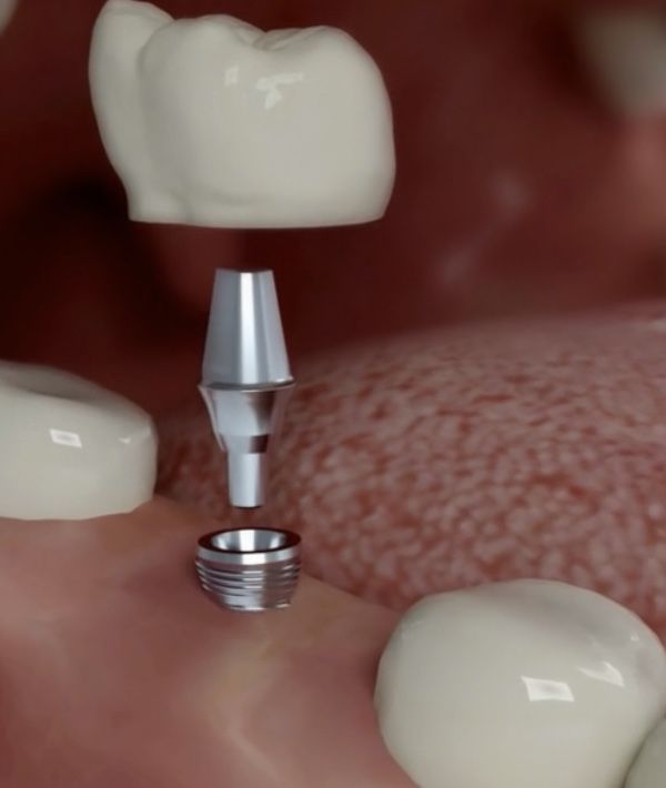 IMPLANTES DE DENTES   em várias tranches        varios pagamentos um  sorriso e expressao facial de excelência