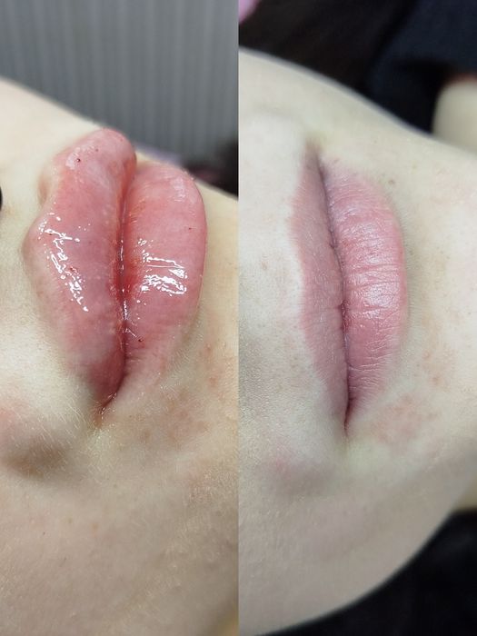Modelowanie i powiększanie UST - 450 zł. 1 ml.