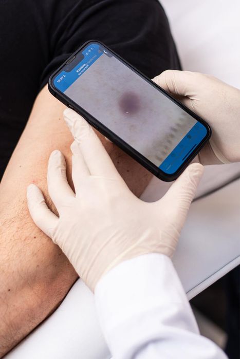 Лазерне видалення папілом