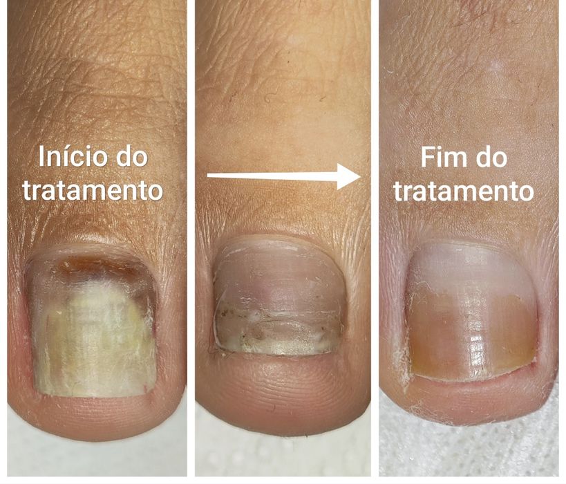 Máquina Laser Nd:YAG 980nm – Tratamento de Onicomicose (fungos unhas)