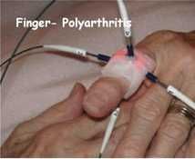 Máquina de Laser Kolina 5a Geração para Acupuntura, Fisioterapia