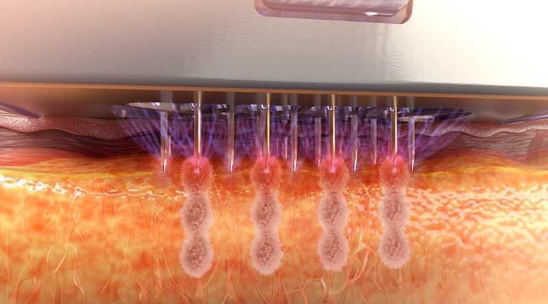 Rf лифтинг, Игольчатый Rf, коррекция рубцов пост акне