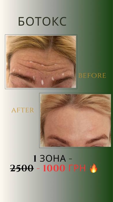 Ботокс!!! Ціна 1000грн.